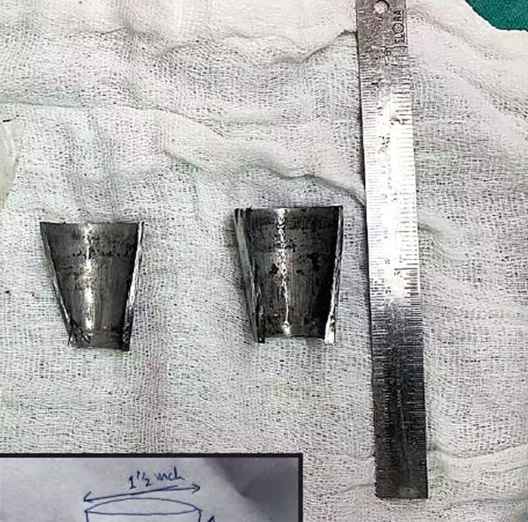 मुंबई: मेटल सेक्स टॉय में फंसा शख्स का प्राइवेट पार्ट, जेजे अस्पताल के चिकित्सकों ने बचाई जान!