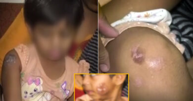 मुंबई में ट्यूशन टीचर ने होमवर्क नहीं कर पाने पर 3 साल की बच्ची को गर्म चिमटे से दागा; चेहरा, घुटना, कंधा जलााया