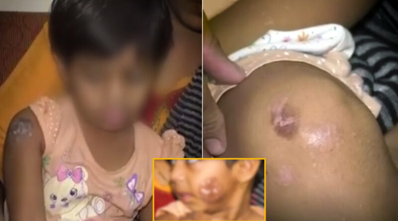 मुंबई में ट्यूशन टीचर ने होमवर्क नहीं कर पाने पर 3 साल की बच्ची को गर्म चिमटे से दागा; चेहरा, घुटना, कंधा जलााया